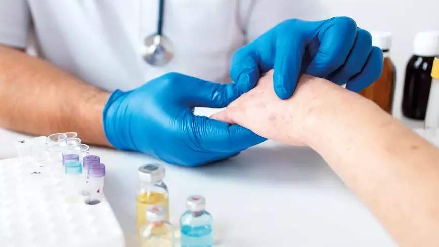 Atópiás dermatitis